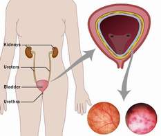 Tiểu khó và cách xử trí